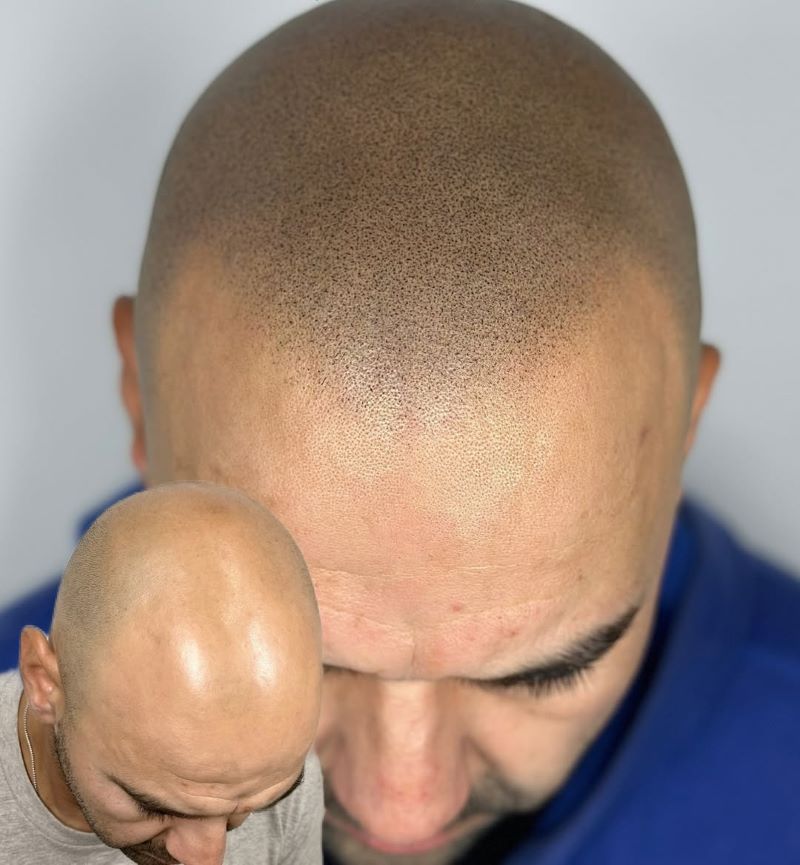 Micropigmentación Capilar 